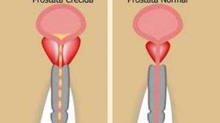 Prostata Vital by ProstataVitalcom Part 1 [upl. by Amandi]