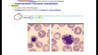 Sideroblastic AnemiaMicrocytic Anemia [upl. by Shugart569]