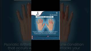 Psoriatic arthritis treatment [upl. by Sari]