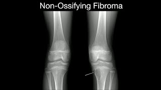 NonOssifying Fibroma 1 [upl. by Aileek]