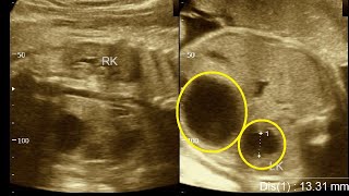 34 weeks pregnancy  Fetal hydronephrosis  Amader hospital  Ultrasonography report  Part  1 [upl. by Lilithe]