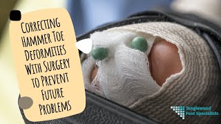 Correcting Hammer Toe Deformities With Surgery to Prevent Future Problems [upl. by Nyrrek]