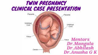 TWIN PREGNANCY Clinical case presentation [upl. by Daenis288]