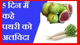 5 दिन मैं कहे पथरी को अलविदा  गुर्दे की पथरी की चमत्कारी दवाई  KIDNEY STONE HOME REMEDIES [upl. by Llewol]