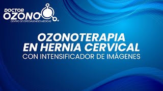 OZONOTERAPIA EN HERNIA CERVICAL CON INTENSIFICADOR DE IMAGENES  DOCTOR OZONO [upl. by Alysia]