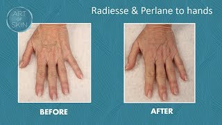 Hand rejuvenation fillers with perlane radiesse amp cannula [upl. by Huberman803]