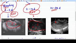 Understanding Endometrium on Sonography [upl. by Ahsikal]