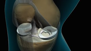 Torn Knee Meniscus Repair [upl. by Gabriellia]