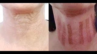 My neck lift non surgical [upl. by Setiram]