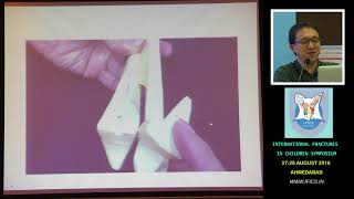 Dr James Hui Triplane and Tillaux Ankle Fractures [upl. by Nellak]