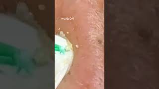 Pickel Ausdrücken Blackheads Akne amp Mitesser entfernen 🔴 24 [upl. by Utter]