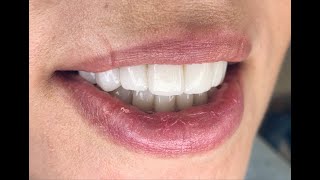 Loredana Austria  Hollywood Smile Review [upl. by Ahsea]