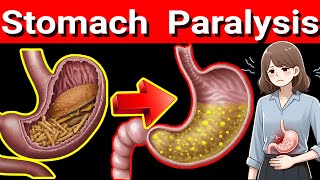 Stomach Paralysis 5 Warning Signs You Shouldnt Ignore Gastroparesis [upl. by Ive646]