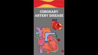 Coronary Artery Disease CAD [upl. by Atiken]