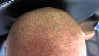 Impressie Micro Hair Pigmentation MHP behandeling bij Beauty Care Nederland BCN te Katwijk [upl. by Nerrot]