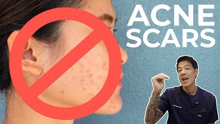 MY SKINCARE ROUTINE FOR DARK SPOTS amp SCARS ‼️ Simple and affordable [upl. by Gran]