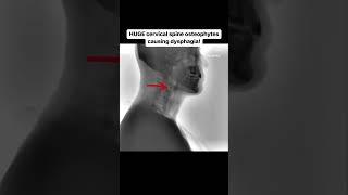 HUGE cervical spine osteophytes causing dysphagia [upl. by Doone454]