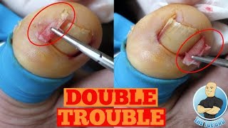 DOUBLE INGROWN TOENAIL REMOVAL FOREVERToe Nail Surgery by The Toe Bro [upl. by Marianna956]