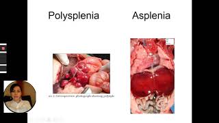 Fetal isomerismHeterotaxy syndromeFetal echocardiography in Azeri language [upl. by Nibram]