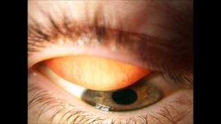 Contact lenses  External examination [upl. by Aitnahc]