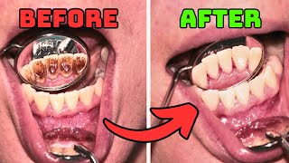 7 Tips to Remove PLAQUE and TARTAR From Teeth Naturally [upl. by Sew]