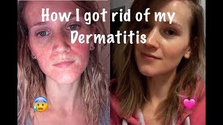 How I Cured My Perioral Dermatitis [upl. by Ntisuj]