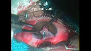 Conjunctival Graft Harvesting For Pterygium Excision With Autograft By Dr Sudhir Singh 32 [upl. by Dielu]