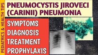 Pneumocystis Jiroveci Pneumonia P Carinii Symptoms Radiology Treatment amp Prophylaxis [upl. by Llerod882]