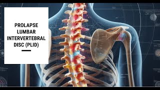 Lumbar Intervertebral Disc Prolapse PLID [upl. by Crawley117]