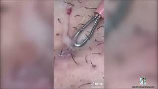 Ultimate Pimple Popping 2024 Painful Acne Extractions [upl. by Creamer]