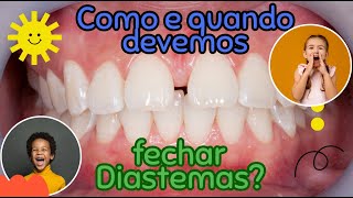 Quando e como fechar diastemas em incisivos superiores anteriores na dentição mista  Aula 144 [upl. by Anilorac]