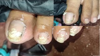 Vlog 1052Dry SkinIngrown Removal PEDICURE 952 [upl. by Erde]