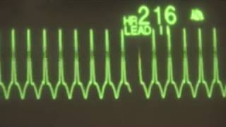 Supraventricular Tachycardia  ECG Training [upl. by Omero]