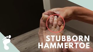 Stubborn Hammertoe amp Follow Up [upl. by Ahtamat]