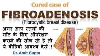 Fibroadenosis cured case [upl. by Tyrone]