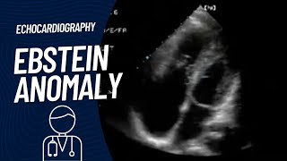 Ebstein Anomaly on Echocardiography [upl. by Tfat200]