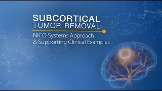 Subcortical Tumor Removal  NICO Systems Approach amp Supporting Clinical Examples [upl. by Hackathorn903]