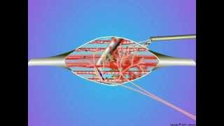 09Trigger Point Dry Needling [upl. by Nesta]