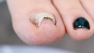 Super CURVED INGROWN Toenail PLUS NAIL REMOVAL [upl. by Guinn]