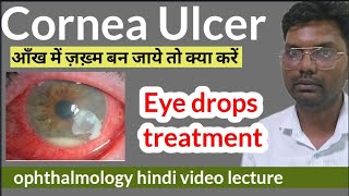 cornea ulcer treatment  cornea foreign body  corneal ulcer treatment  cornea ulcer eye drops [upl. by Aihtnic]