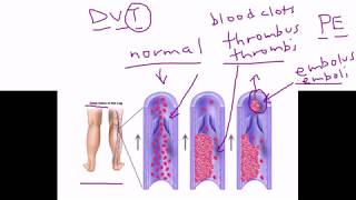 Deep Venous Thrombosis DVT [upl. by Thill]