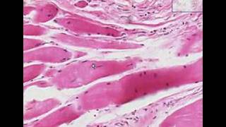 Histopathology Skeletal muscle  Muscular dystrophy [upl. by Allit357]