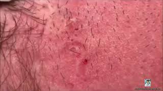 Ultimate Pimple Popping 2024 Satisfying Acne Treatments [upl. by Lalage]