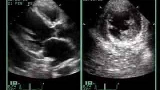 AC ANTEROSEPTAL MYOCARDIAL INFARCTION [upl. by Eednar]