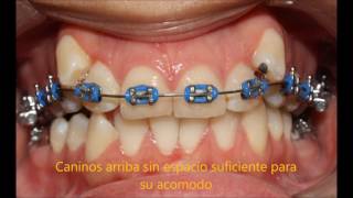 CASO ORTODONCIA MINIIMPLANTES DISTALIZACION MOLARES [upl. by Mcgrody]