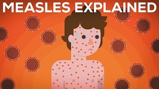 Measles Explained — Vaccinate or Not [upl. by Ilrahs585]