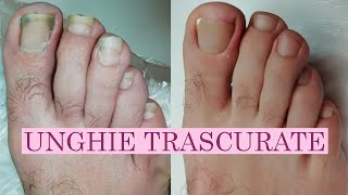 Pedicure unghie trascurate incarnite e onicolisi [upl. by Merline482]