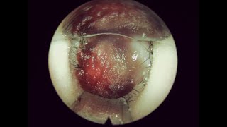 移除鼻填塞 Removal of Nasal Packing  PosiSep  004 [upl. by Akiv270]