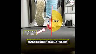 Understanding Plantar Fasciitis amp Over Pronation How Orthotic Insoles Can Help Control and Relieve [upl. by Resor]