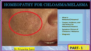 HOMEOPATHY FOR CHLOASMAMELASMA  what is melasma sign and symptoms treatmentDr Priyanka Saini [upl. by Ahseele]